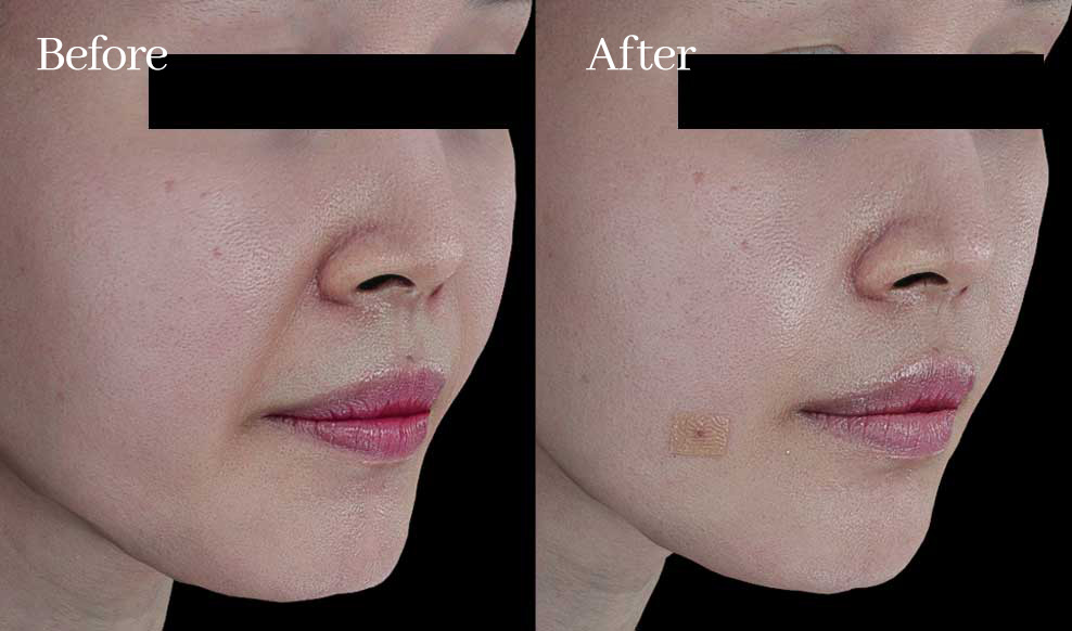 커스텀 디자인 필러