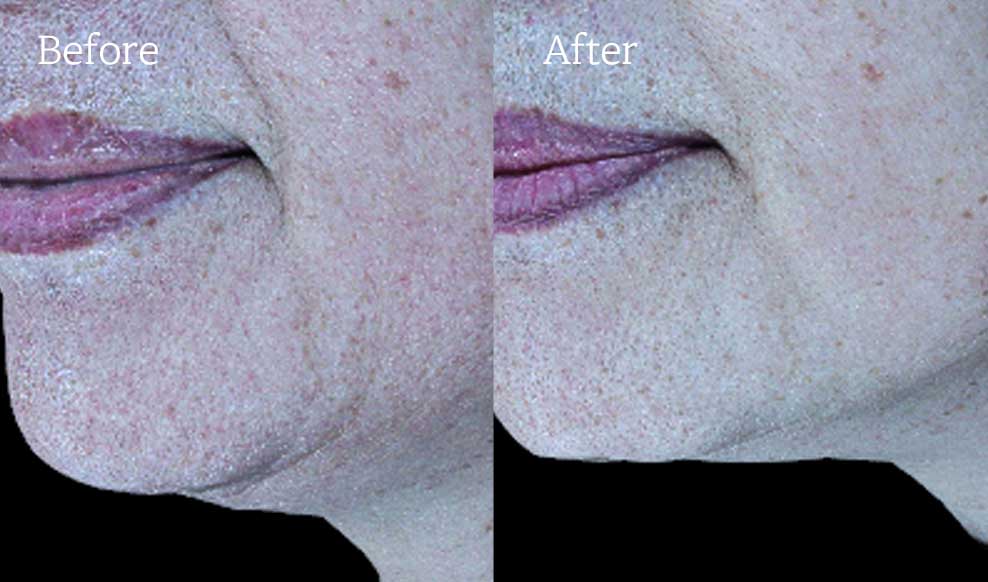 커스텀 디자인 필러