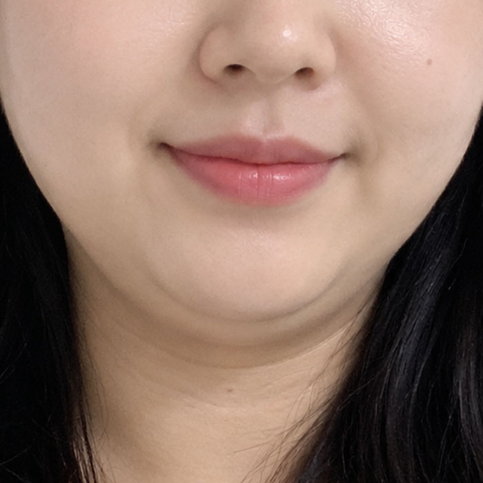 울쎄라프라임추천1